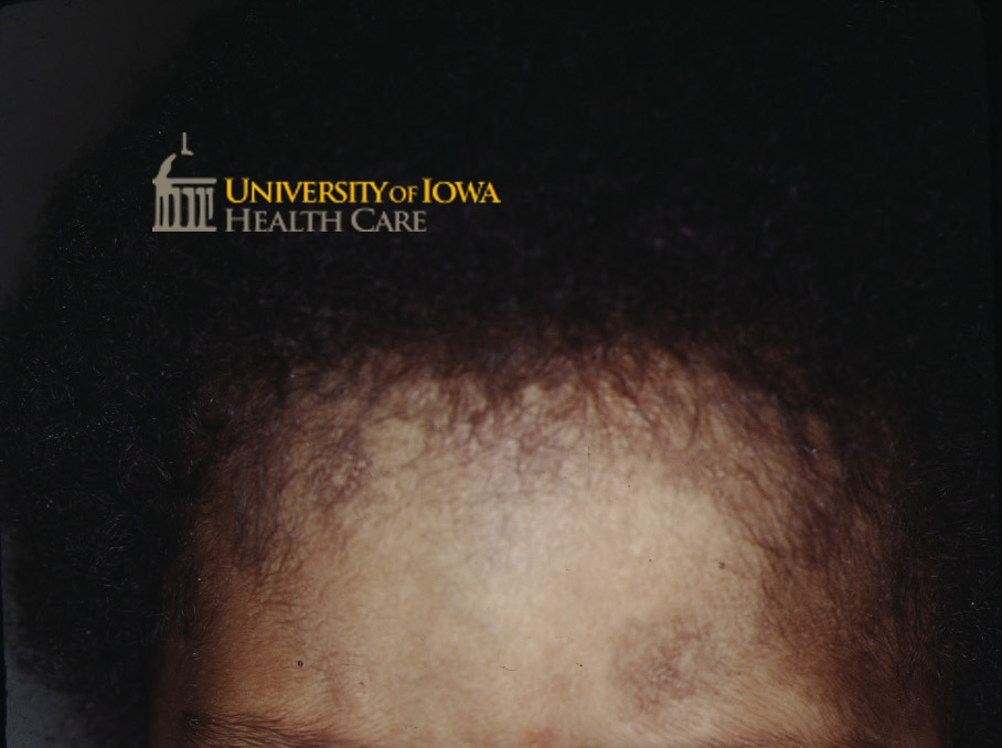 Hypo- and hyperpigmented patches on the forehead and nose at site of prior candidal infection. (click images for higher resolution).